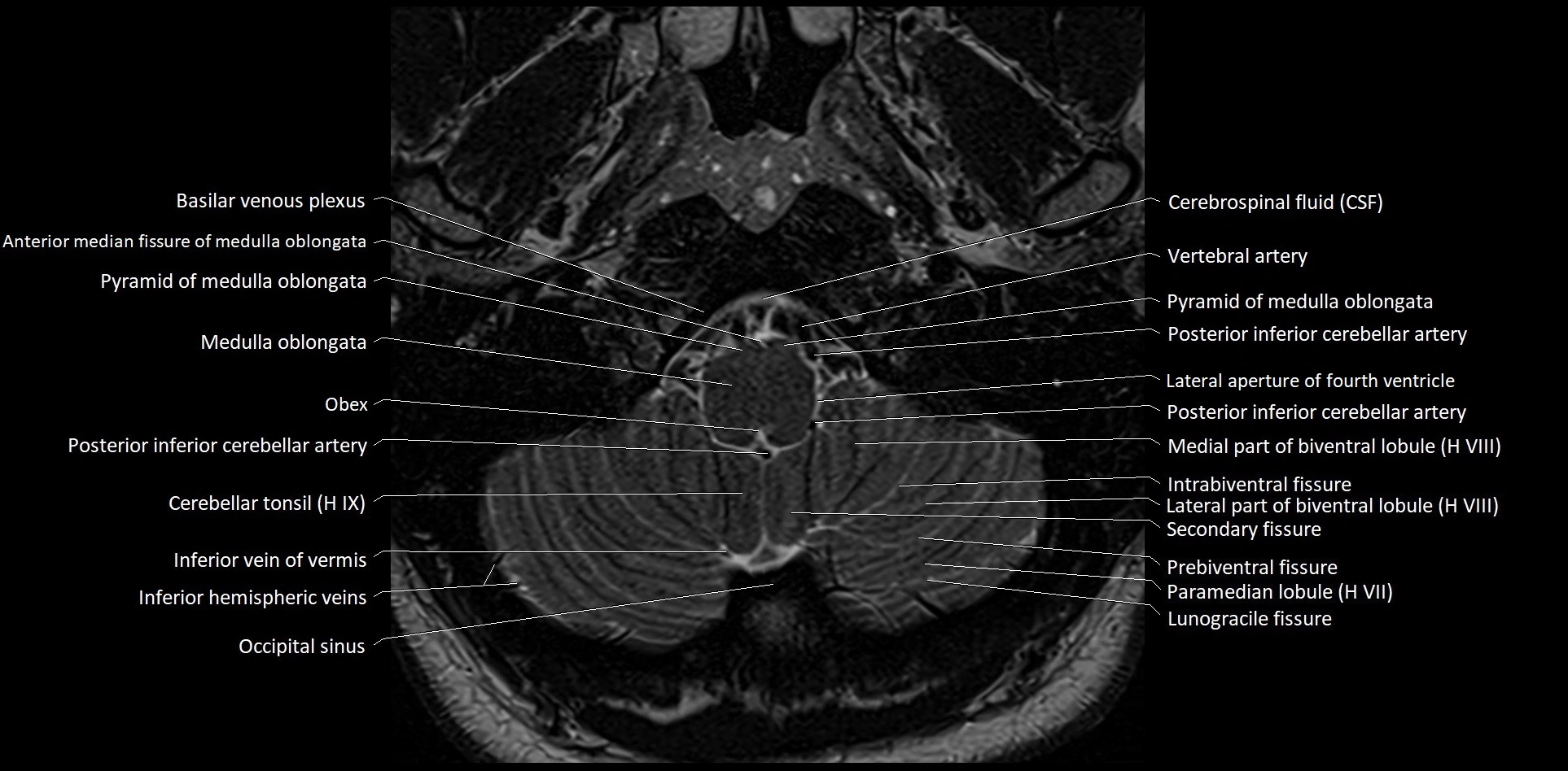 MRI Cerebellar anatomy High-resolution labelled 3T MRI image 4.webp